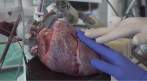 Com técnica inovadora, primeira cirurgia cardíaca fora do corpo é realizada na Holanda 2