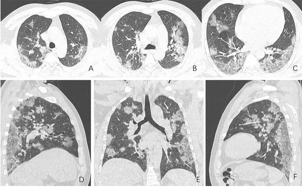 Covid-19 pode gerar sequelas graves em pulmões de pacientes curados, aponta revista científica norte-americana 3