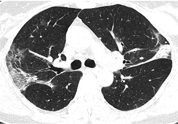 Covid-19 pode gerar sequelas graves em pulmões de pacientes curados, aponta revista científica norte-americana 1