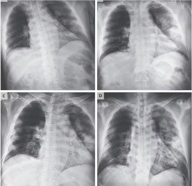 Covid-19 pode gerar sequelas graves em pulmões de pacientes curados, aponta revista científica norte-americana 3